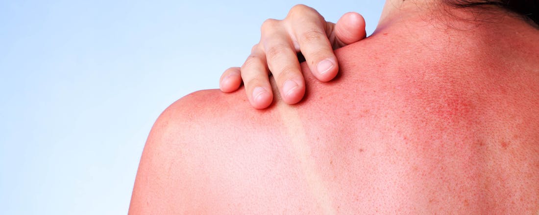 Vrouw met erg verbrande schouders Help! Eerste hulp bij verbranding door de zon